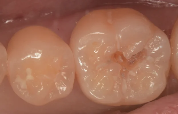 様子を見ていた所が進んだため治療介入。|坂寄歯科医院(取手市藤代) - 画像2