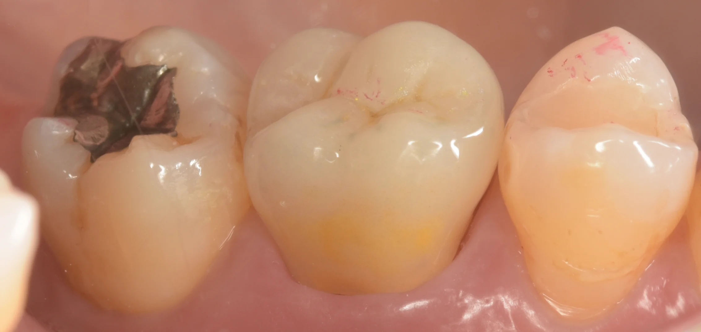 セラミックの被せ物｜坂寄歯科医院（取手市藤代） - 画像4