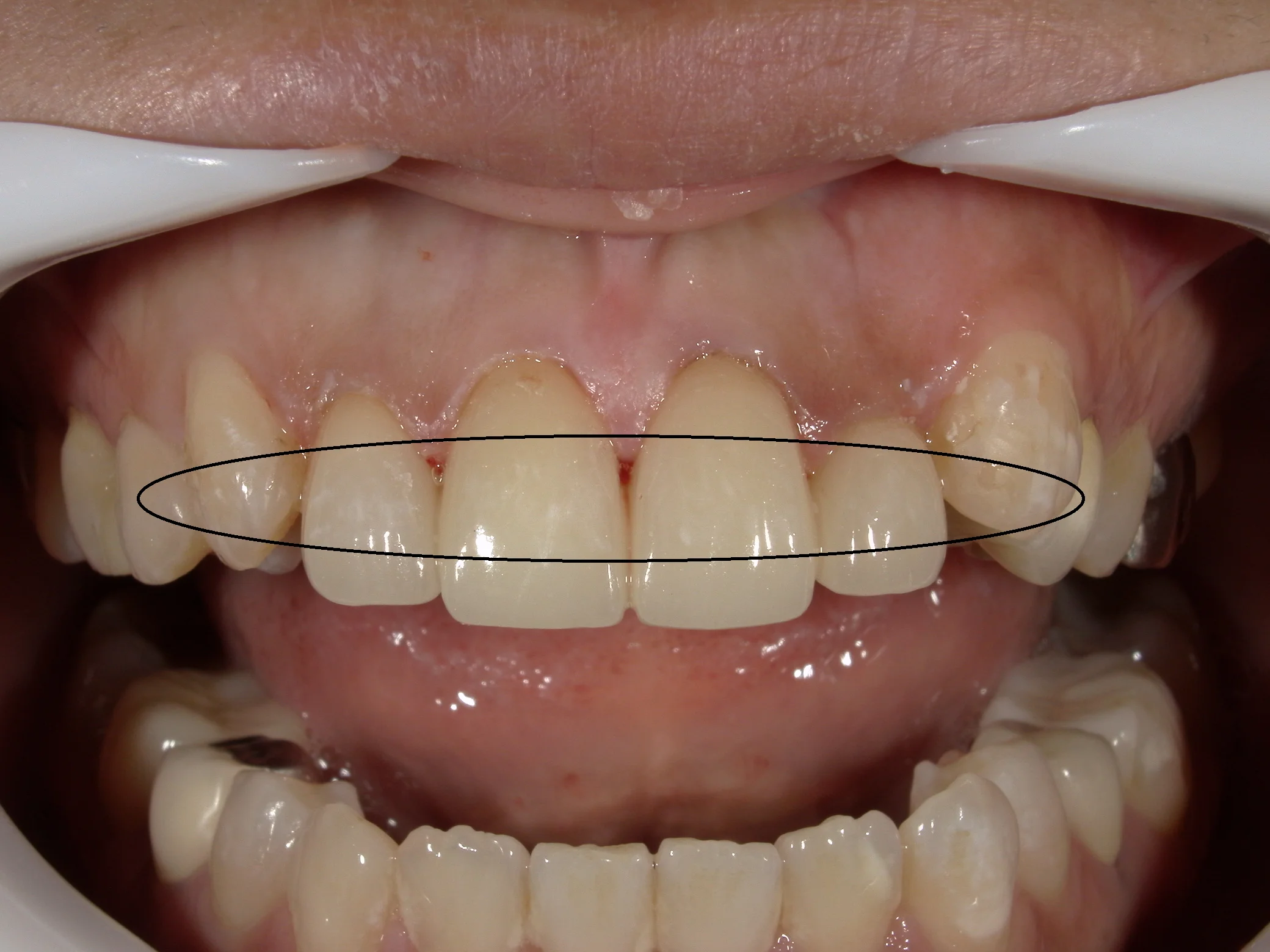 前歯セラミッククラウン|坂寄歯科医院(取手市藤代) - 画像2