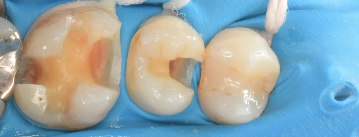 歯科医師の方を治療。｜坂寄歯科医院（取手市藤代） - 画像3