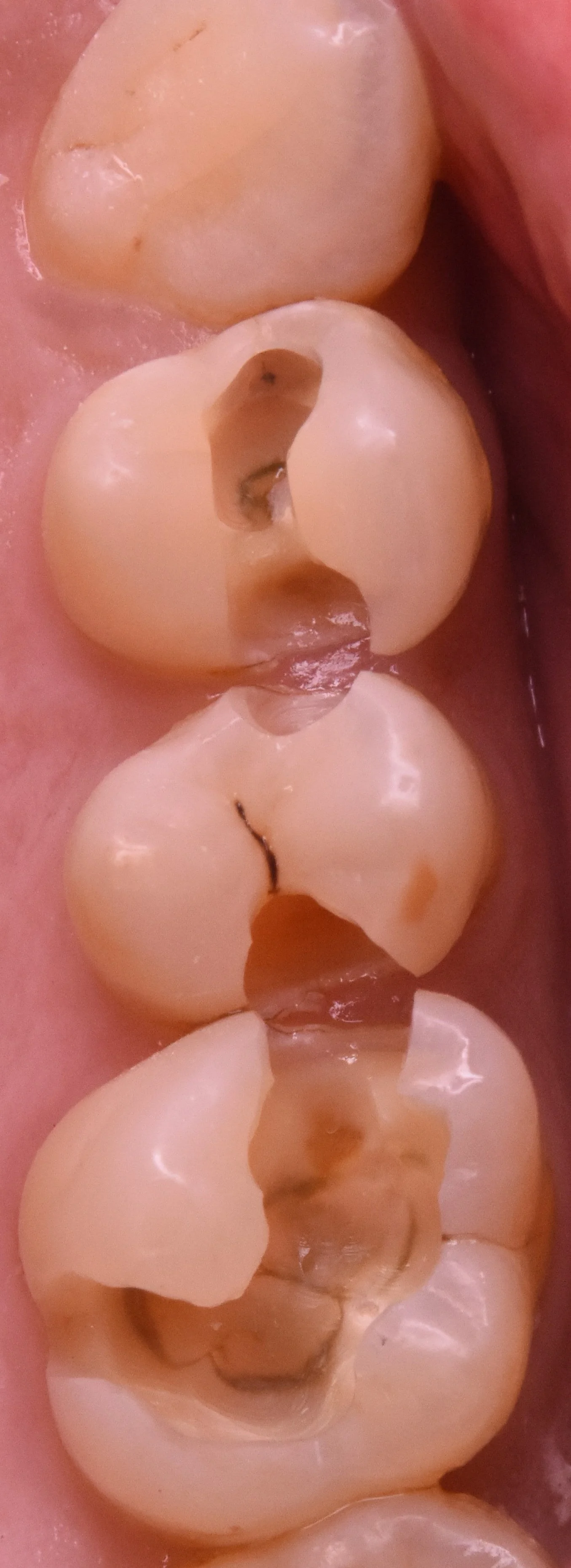 奥歯3本を纏めて一気に治療。|坂寄歯科医院(取手市藤代) - 画像3