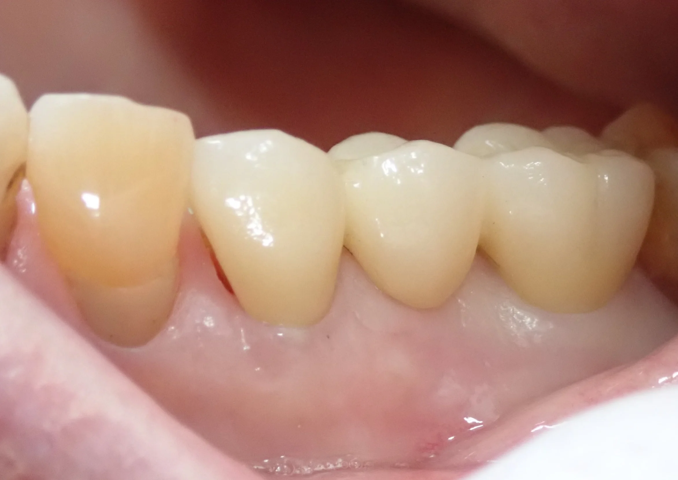 仮歯へのこだわり|坂寄歯科医院(取手市藤代) - 画像3