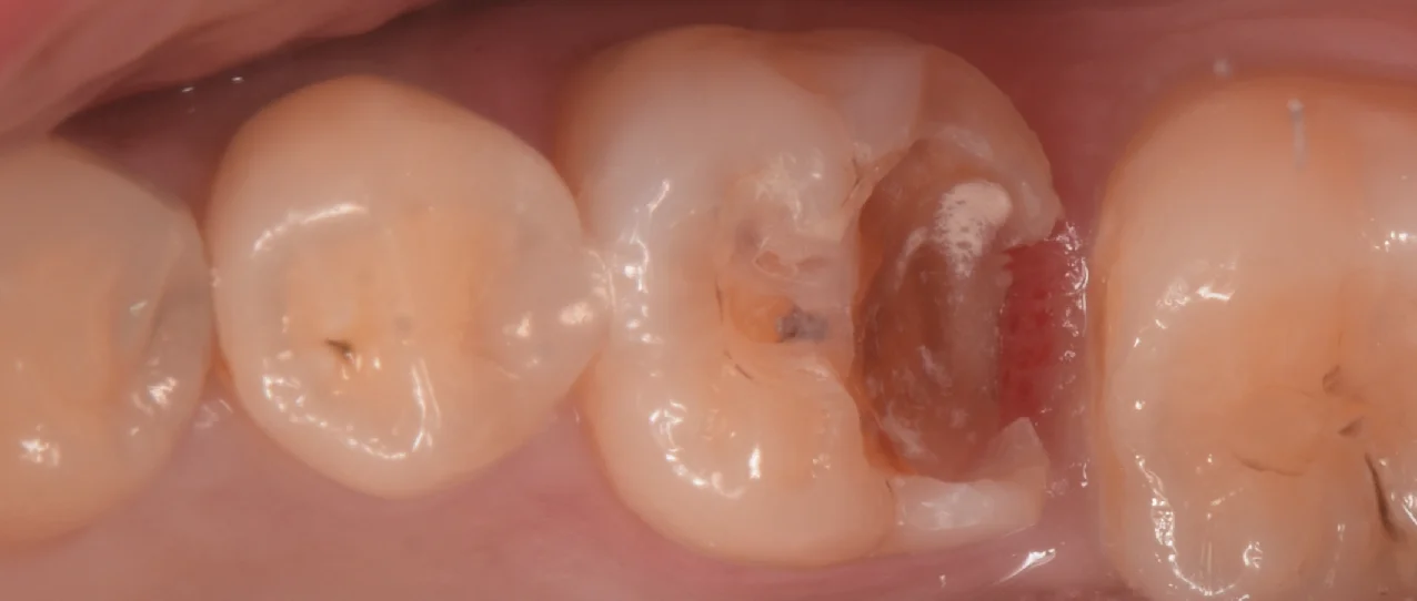 歯科医師の方のCAD/CAMインレーを治療。｜坂寄歯科医院（取手市藤代） - 画像2