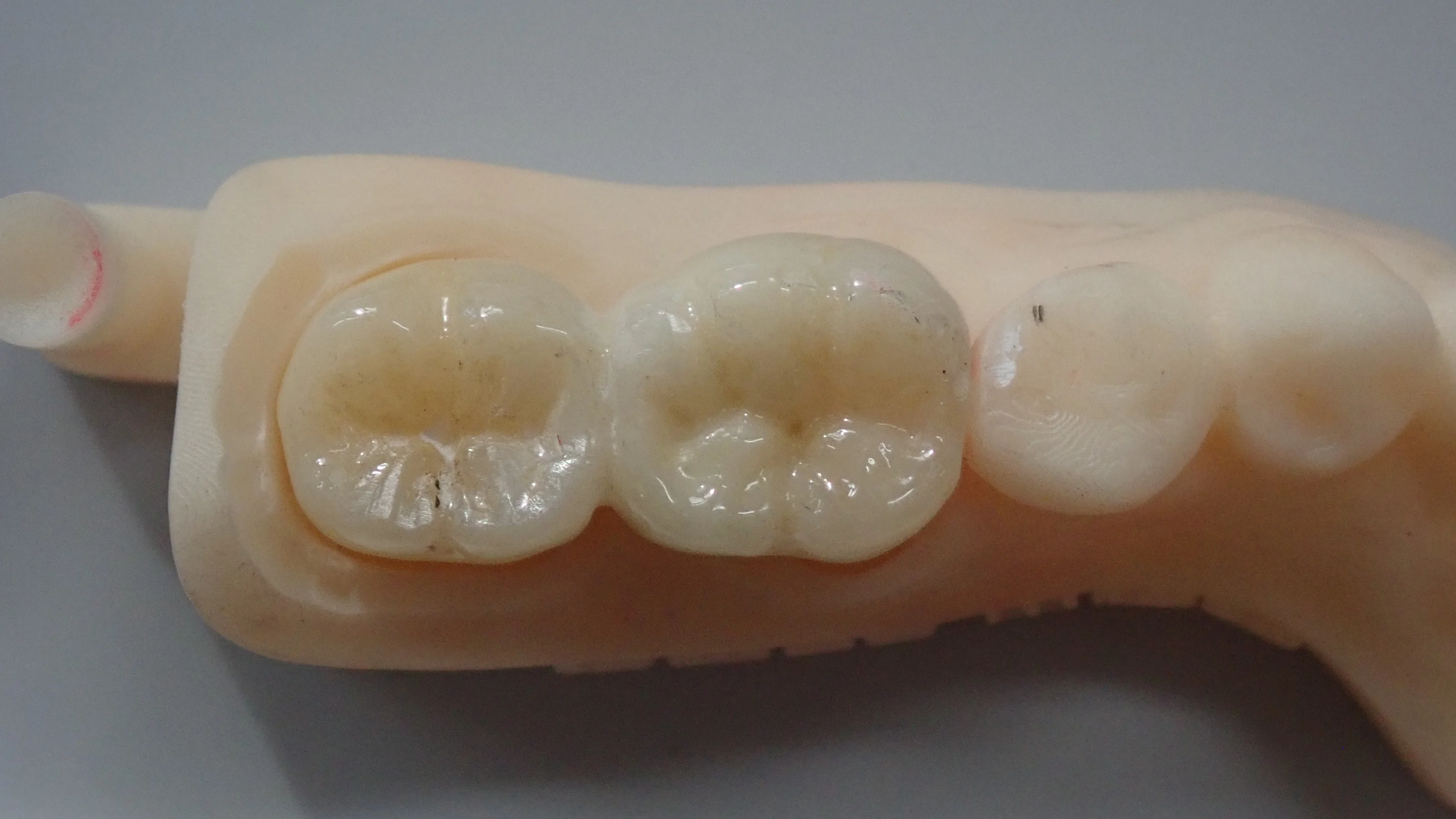 その抜歯ちょっと待って！｜坂寄歯科医院（取手市藤代） - 画像5