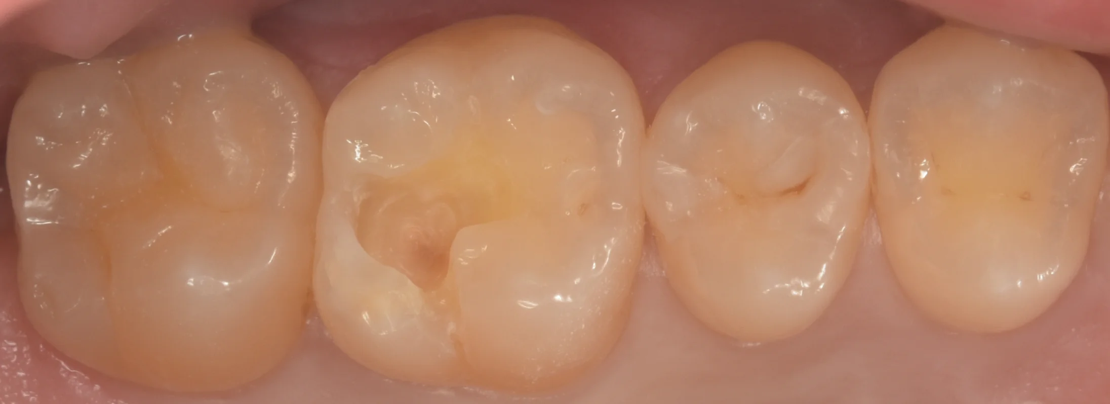 遠方より歯の治療を希望して｜坂寄歯科医院（取手市藤代） - 画像3