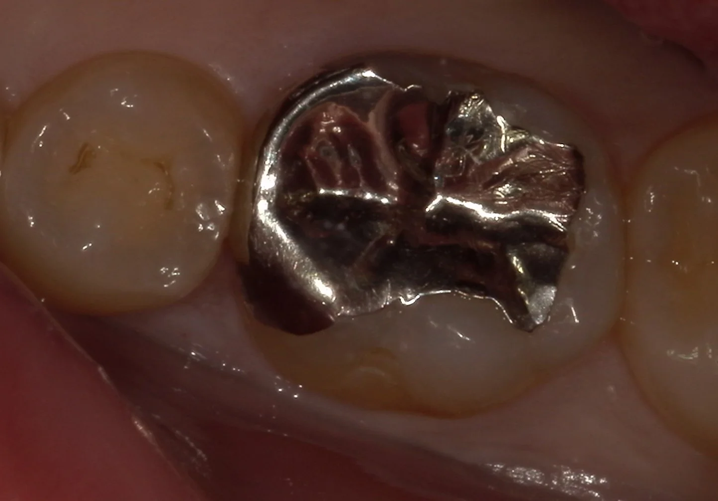 難易度の高い白い詰め物。|坂寄歯科医院(取手市藤代)