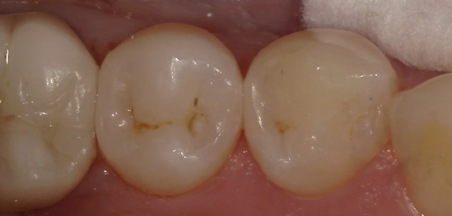 右下奥歯を纏めて治療。遠方からの通院。｜坂寄歯科医院（取手市藤代） - 画像4