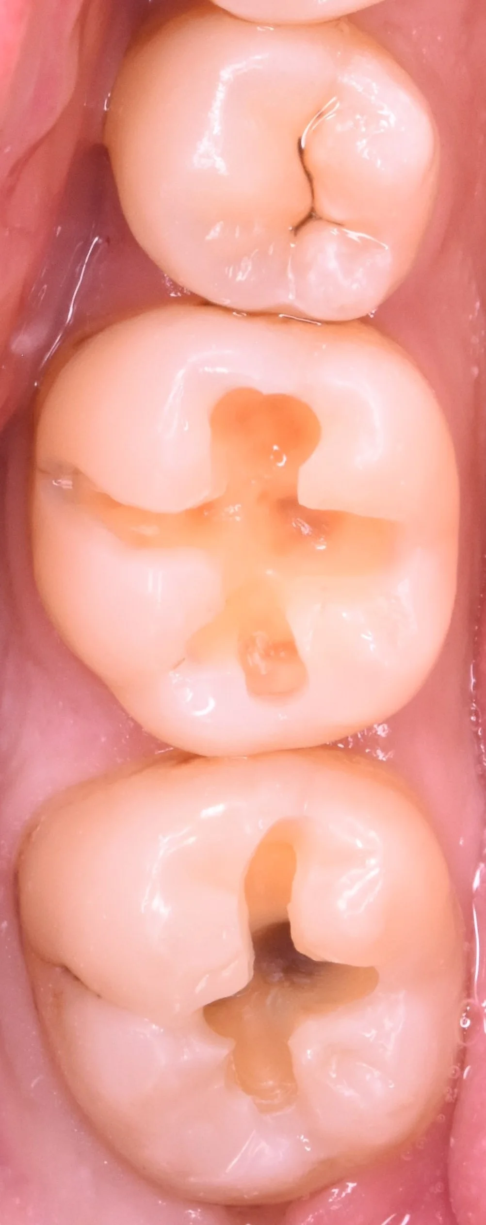 奥歯2本の治療を1日で。|坂寄歯科医院(取手市藤代) - 画像3