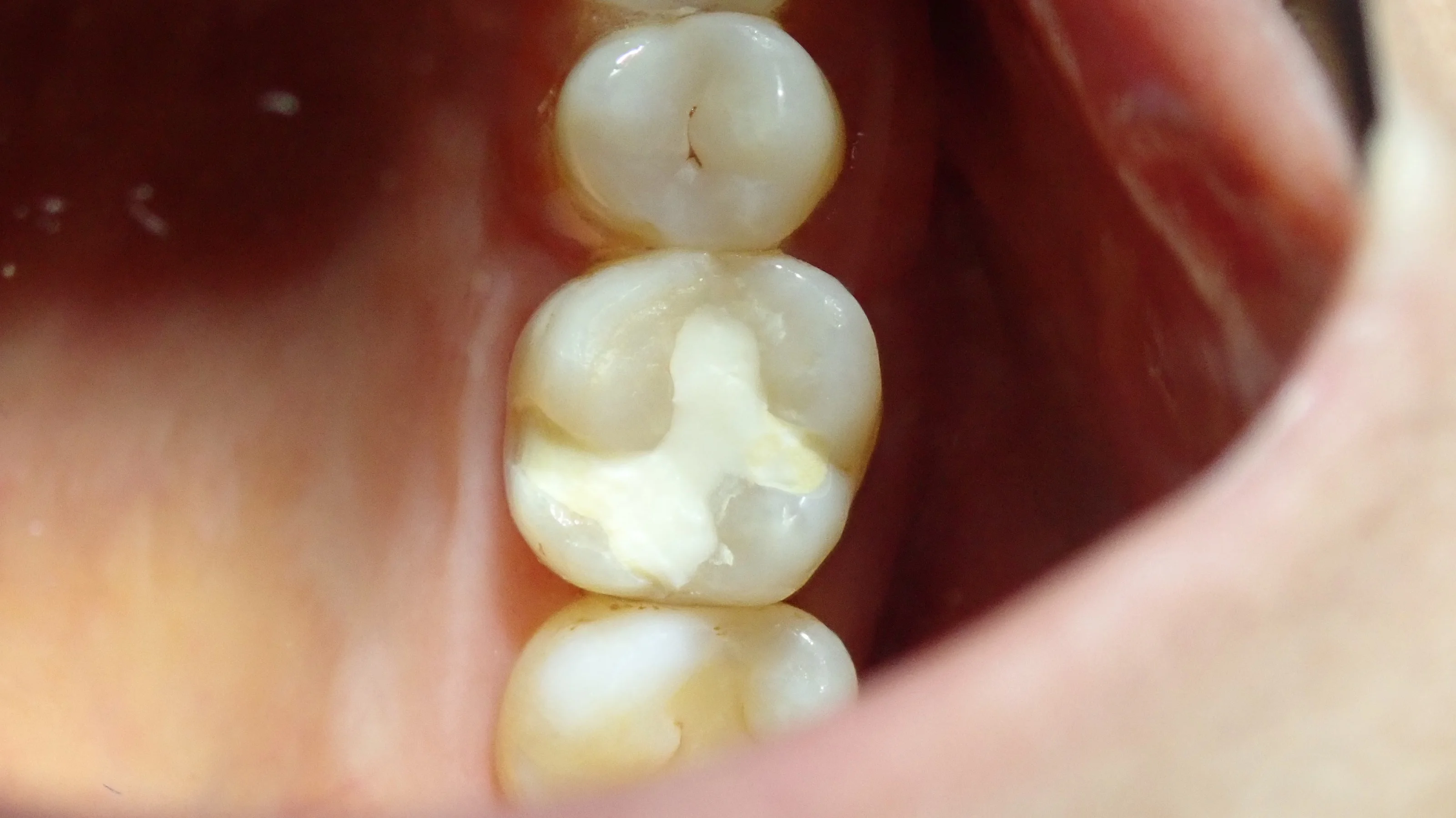 ダイレクトボンディング③（臼歯）｜坂寄歯科医院（取手市藤代）