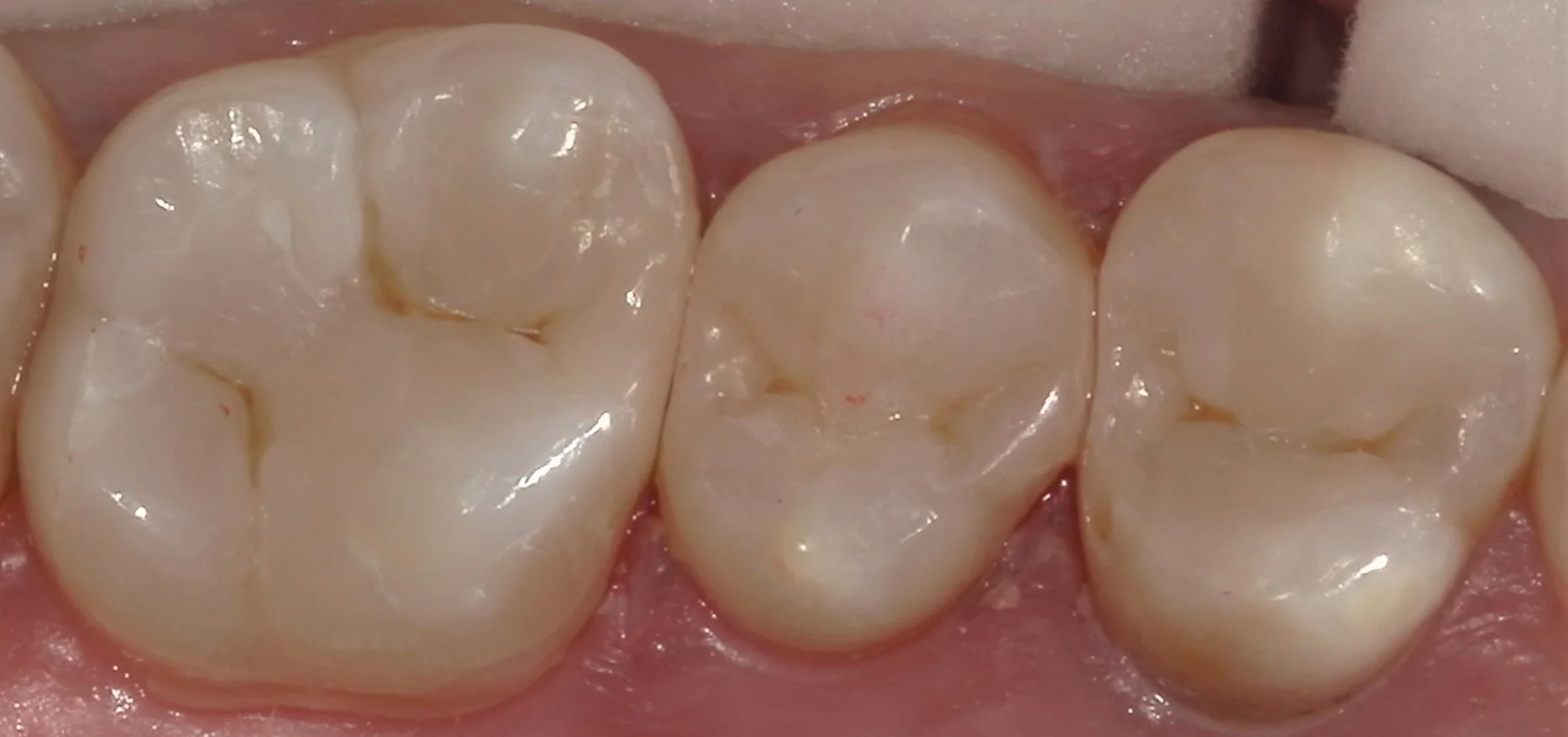 遠方から来院の方を白い詰め物にて治療。｜坂寄歯科医院（取手市藤代） - 画像7