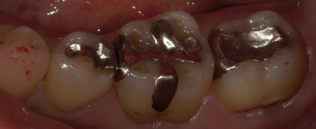 遠方から纏めて治療を希望の方。｜坂寄歯科医院（取手市藤代）