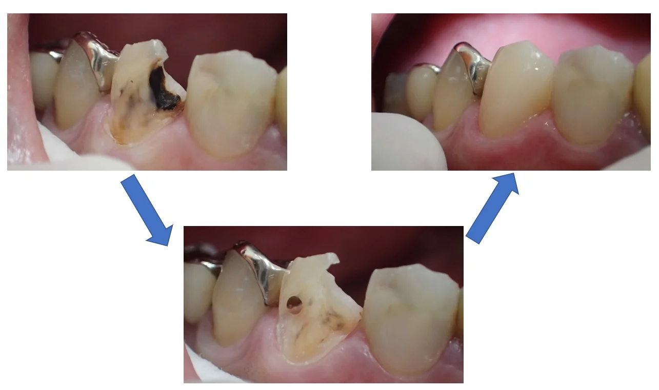 前歯のダイレクトボンディング｜坂寄歯科医院（取手市藤代） - 画像2