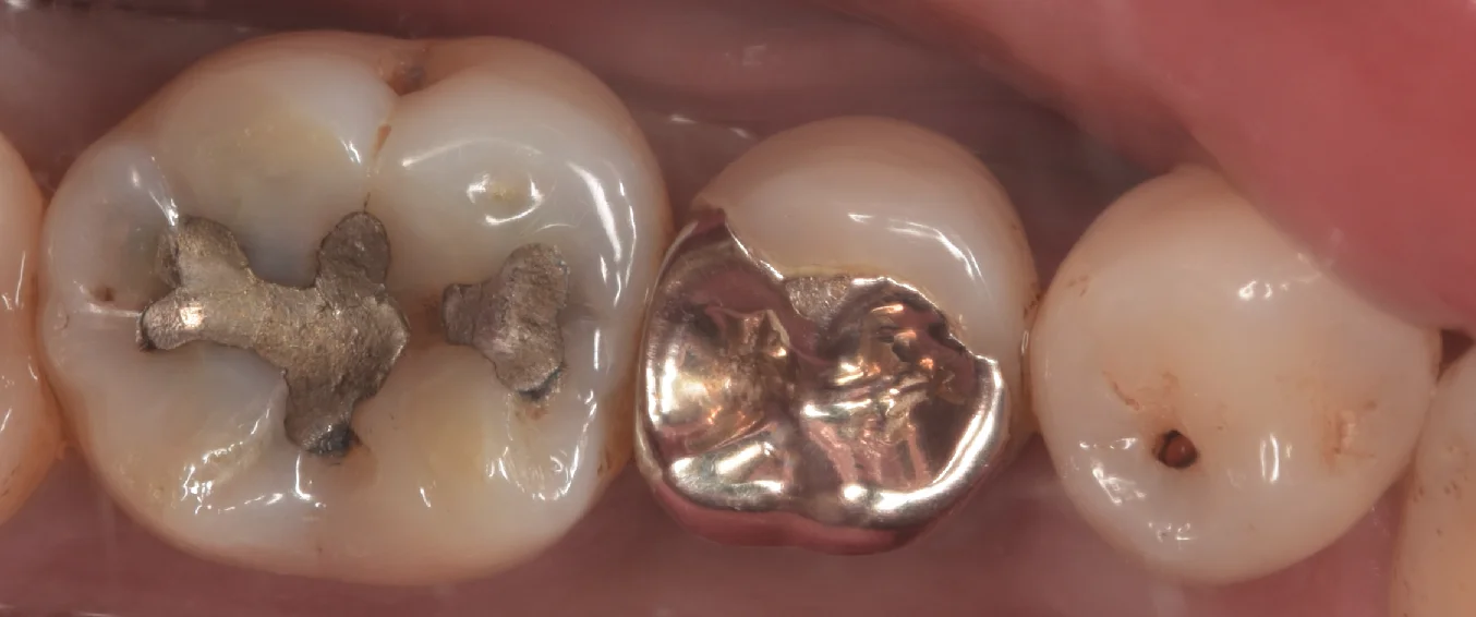 古い金属にできた虫歯をその日のうちに白い詰め物で。｜坂寄歯科医院（取手市藤代）