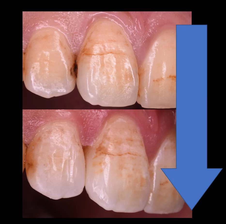 前歯の虫歯の治療で可能な限り歯を温存したケース。｜坂寄歯科医院（取手市藤代） - 画像5