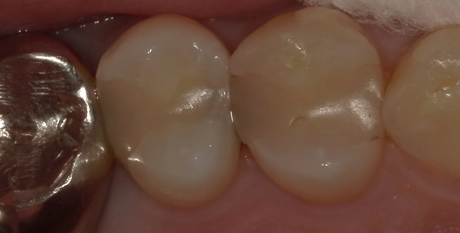 保険内の白い詰め物(コンポジットレジン修復)｜坂寄歯科医院（取手市藤代）