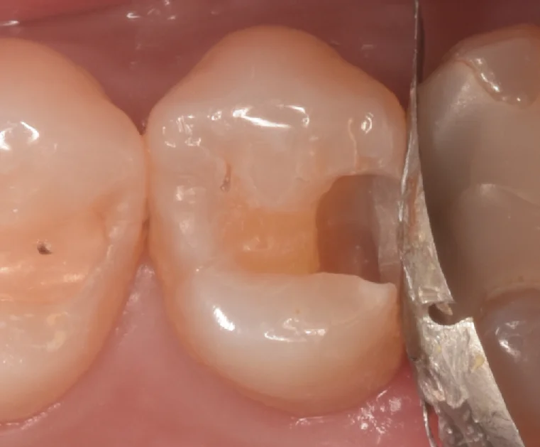 開業歯科医師の方を治療。｜坂寄歯科医院（取手市藤代） - 画像3