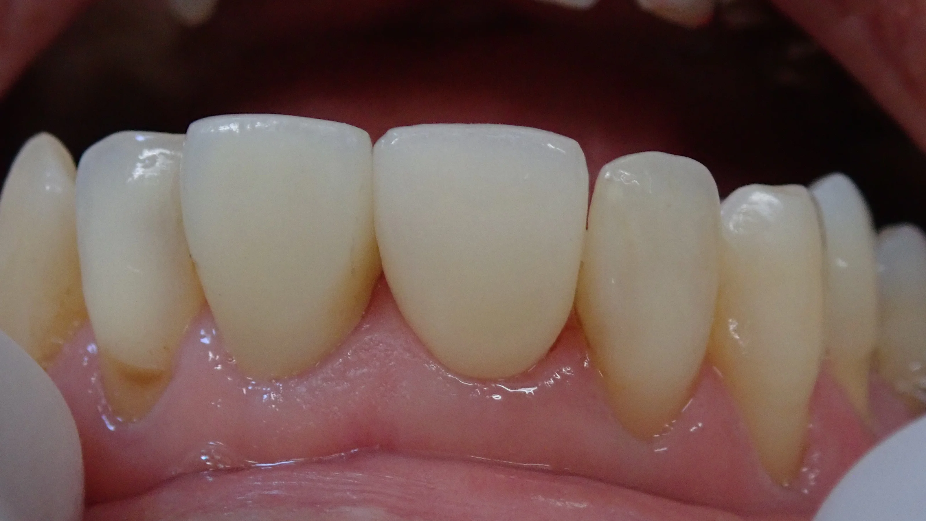 仮歯へのこだわり。その2|坂寄歯科医院(取手市藤代) - 画像3