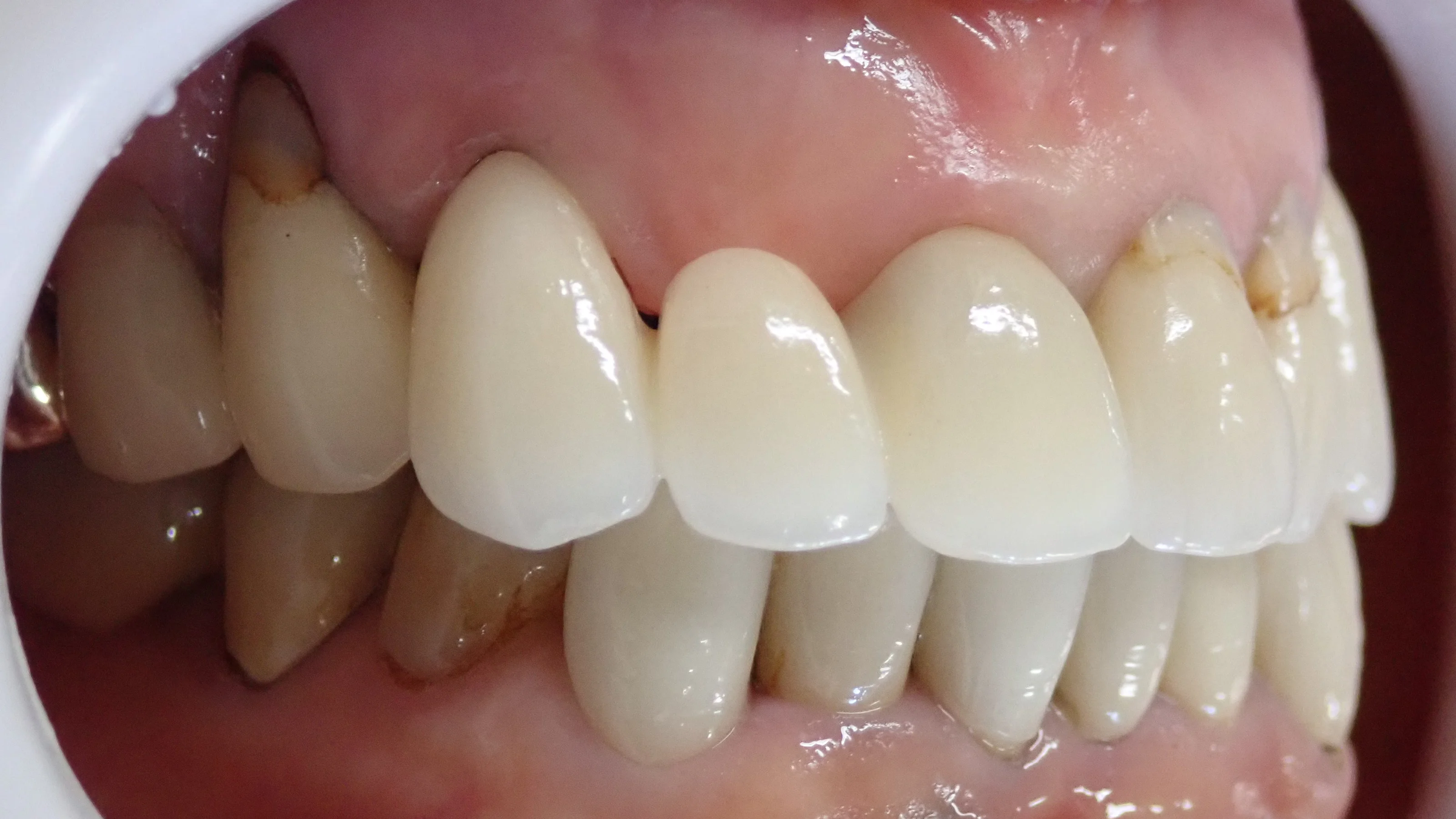 オールセラミックスブリッジ|坂寄歯科医院(取手市藤代) - 画像3