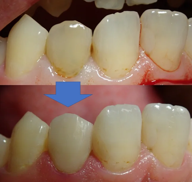 前歯のダイレクトベニア|坂寄歯科医院(取手市藤代) - 画像5
