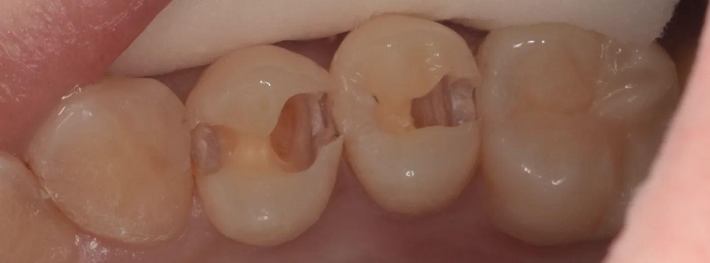 通常の保険診療。|坂寄歯科医院(取手市藤代) - 画像3