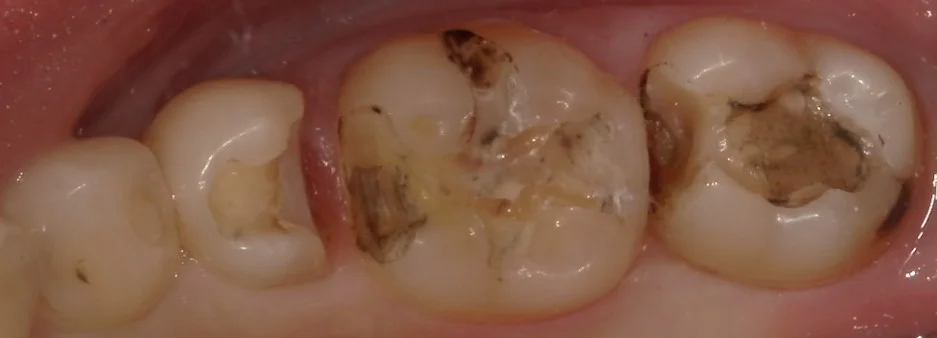 1回で纏めて一気に白い歯へ。|坂寄歯科医院(取手市藤代) - 画像2