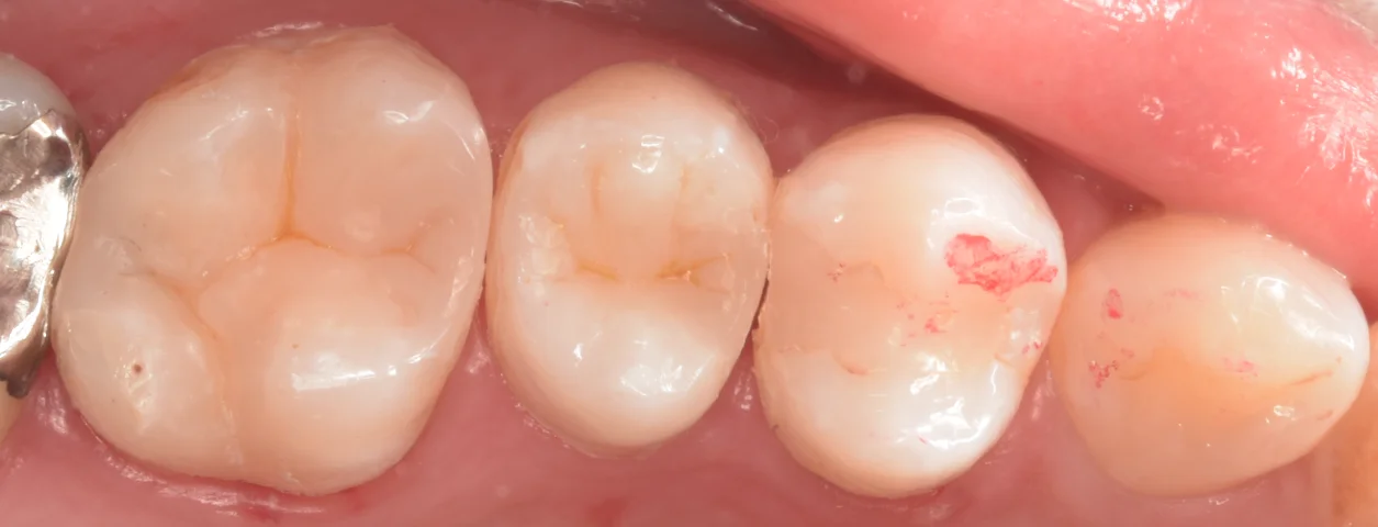 歯科医師の方を治療。｜坂寄歯科医院（取手市藤代） - 画像4