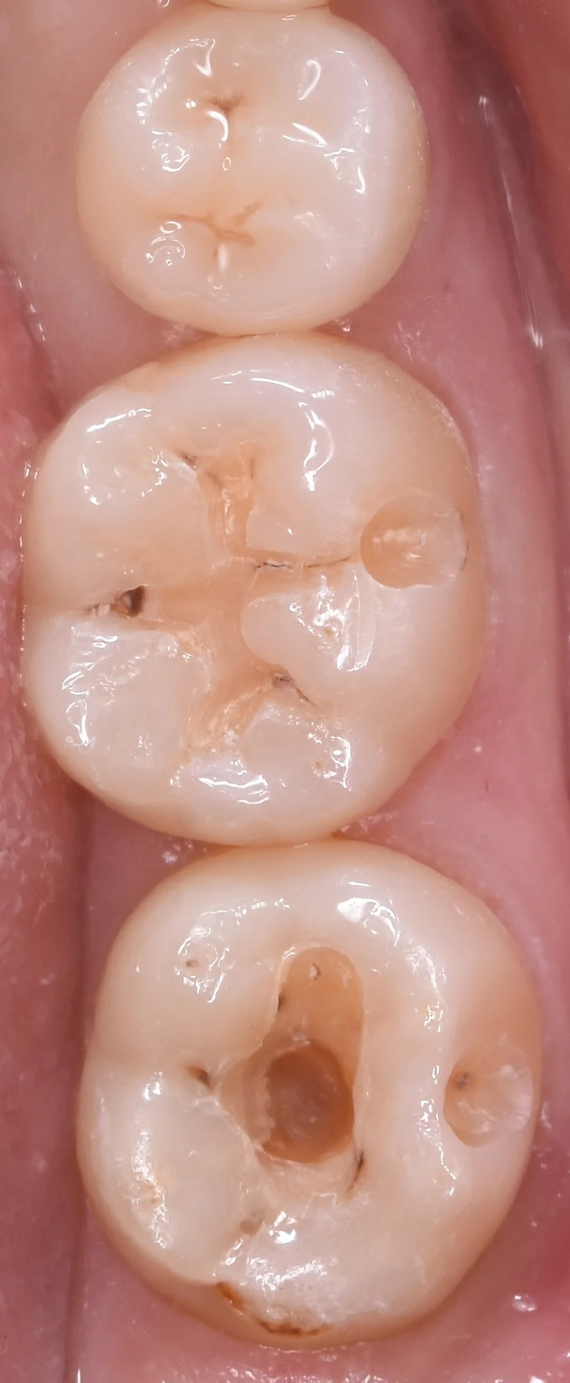 他県にて勤務中の歯科衛生士の方の治療。｜坂寄歯科医院（取手市藤代） - 画像2