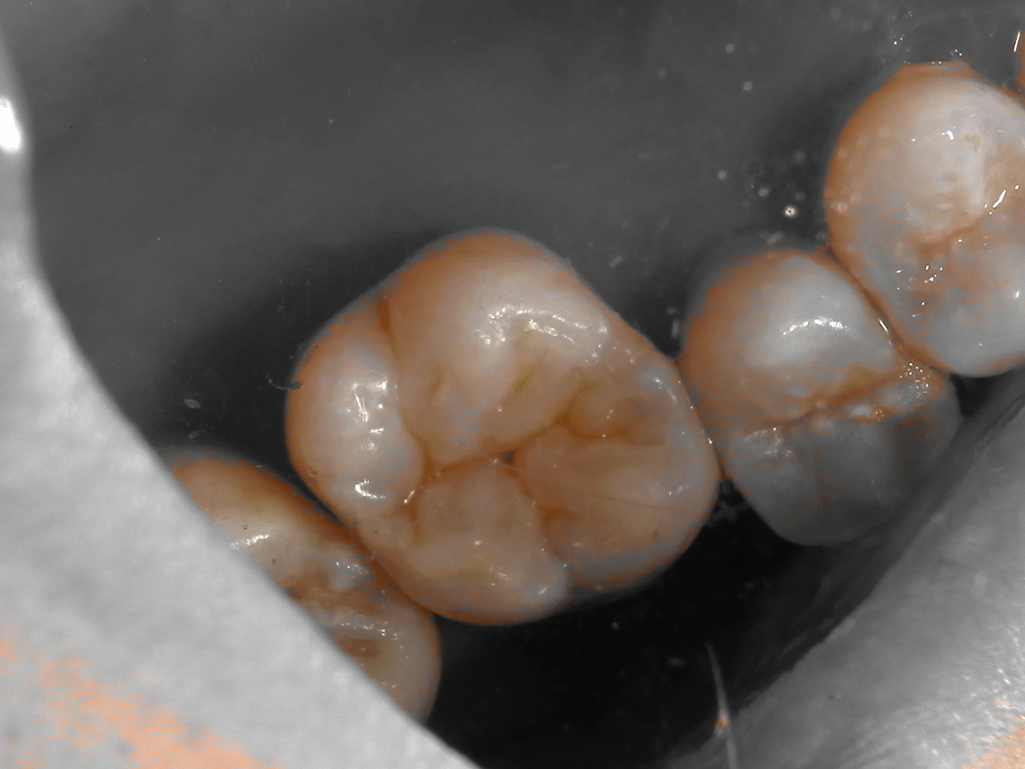 右上6ダイレクトボンディング|坂寄歯科医院(取手市藤代) - 画像6