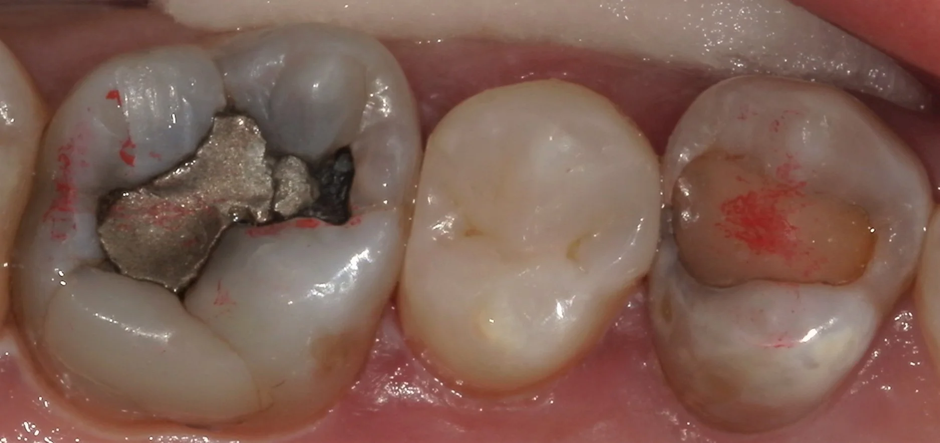 遠方から来院の方を白い詰め物にて治療。｜坂寄歯科医院（取手市藤代） - 画像4