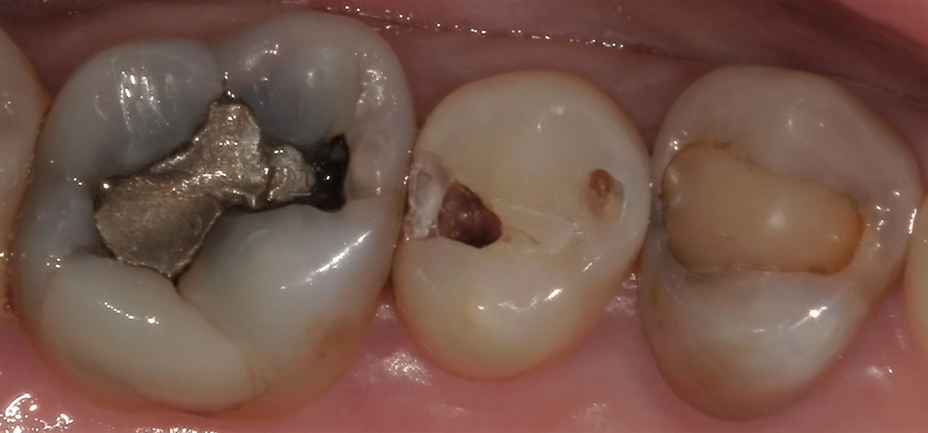 遠方から来院の方を白い詰め物にて治療。｜坂寄歯科医院（取手市藤代） - 画像2