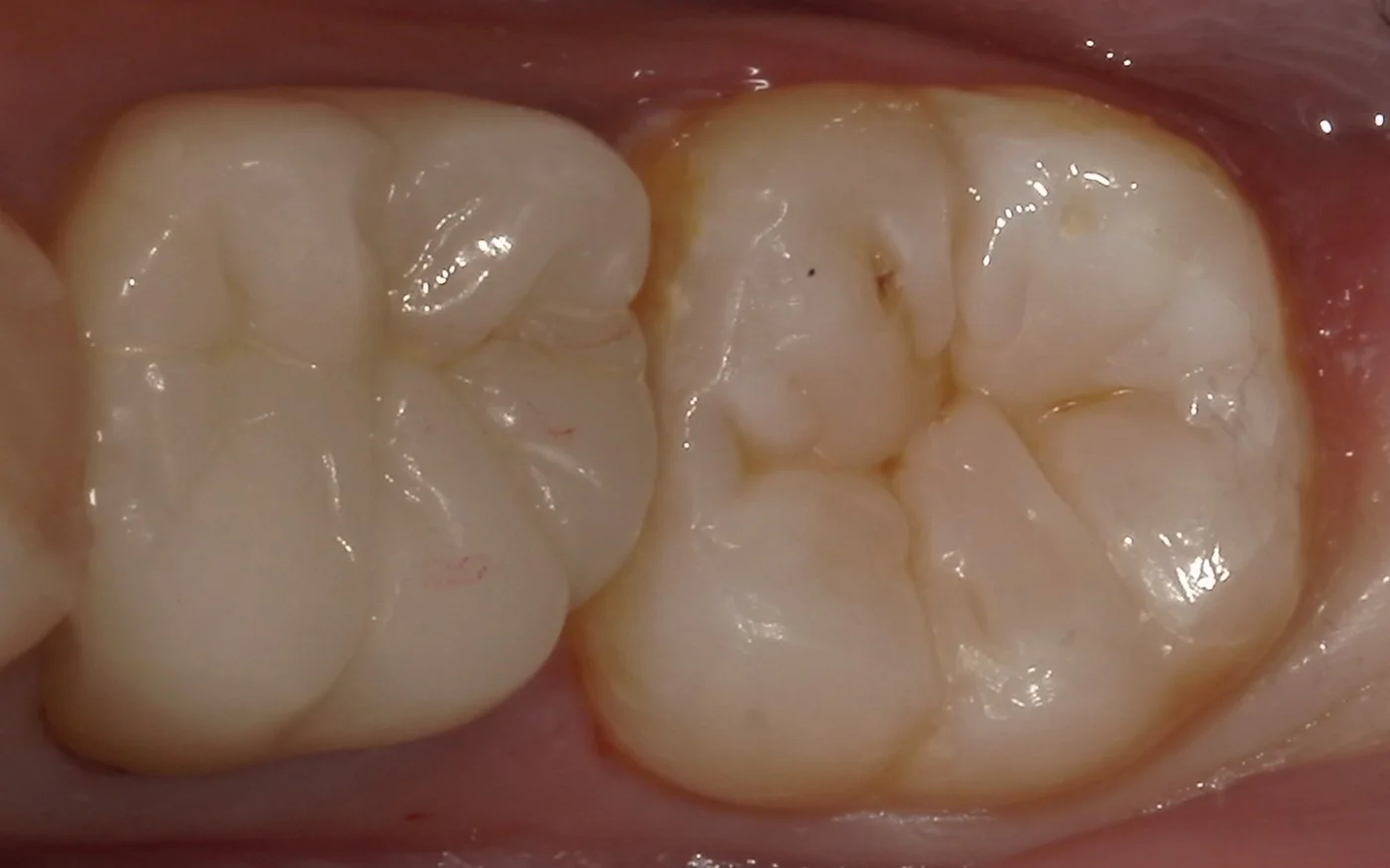 遠方より虫歯の治療で通院された方を一日で治療しました。｜坂寄歯科医院（取手市藤代） - 画像4