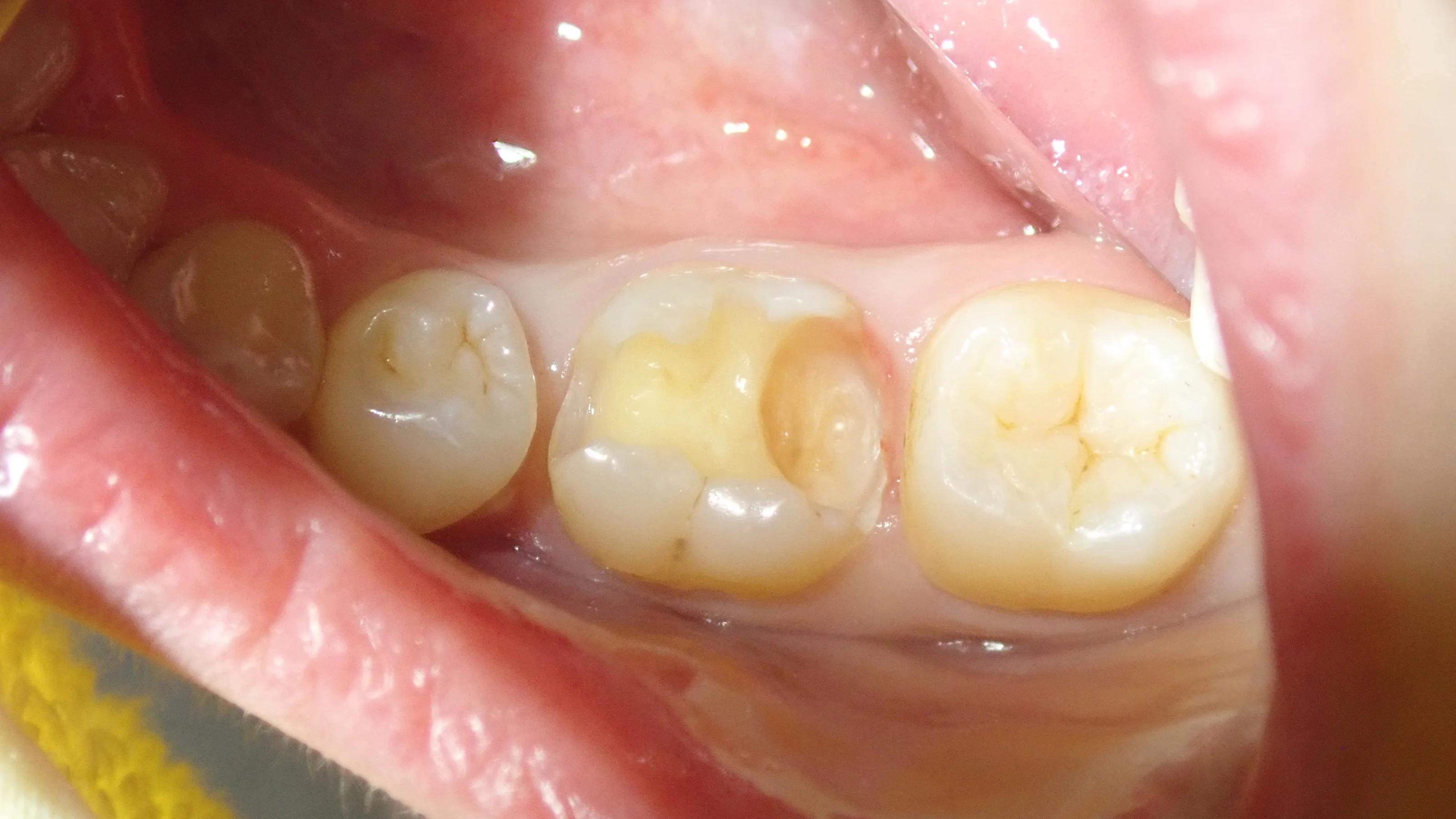 奥2本のダイレクトボンディング|坂寄歯科医院(取手市藤代) - 画像6