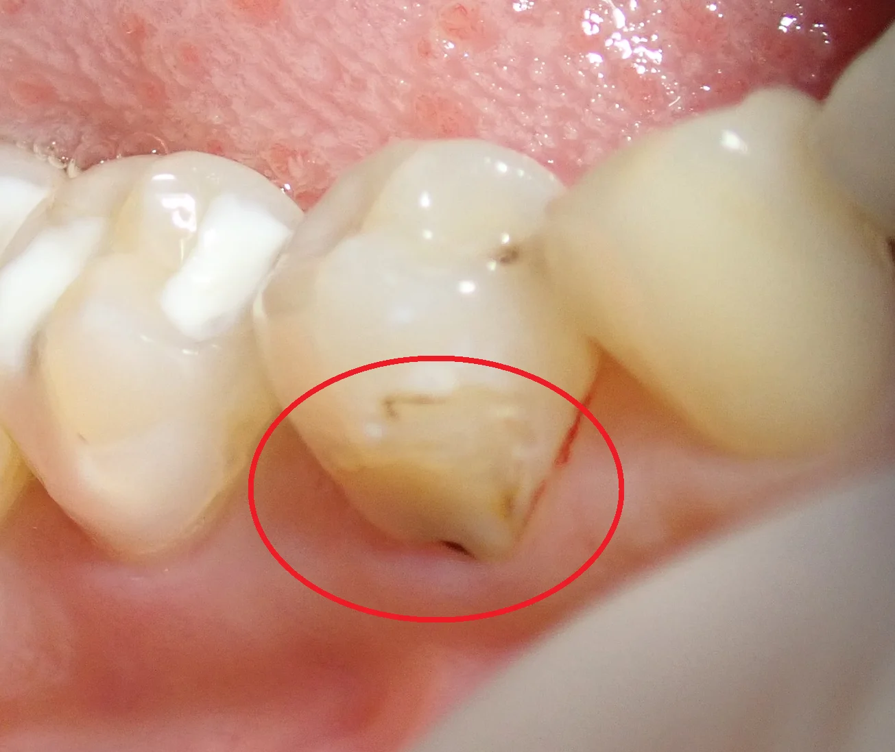 圧排糸を使ったレジン治療。｜坂寄歯科医院（取手市藤代）