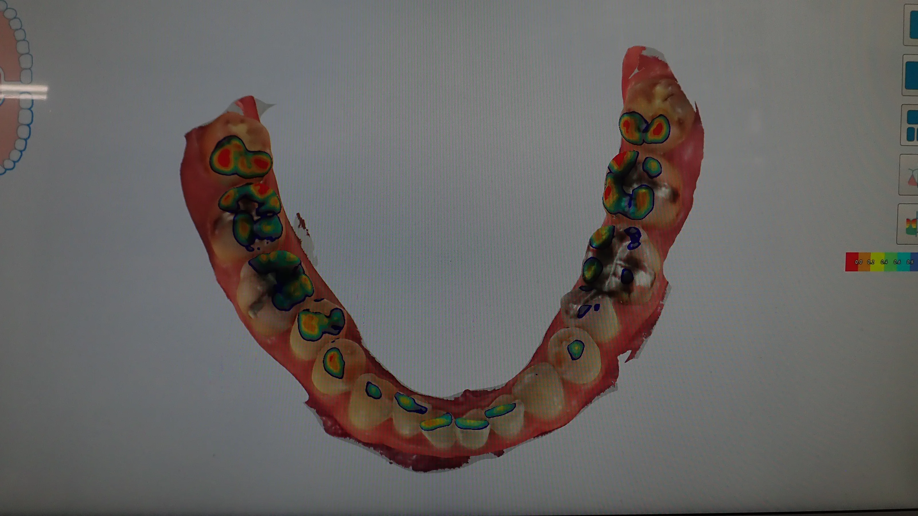 口腔内スキャナを導入しました。|坂寄歯科医院(取手市藤代) - 画像3