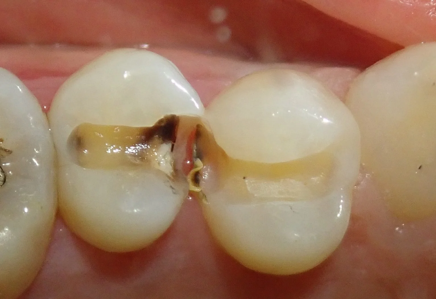 保険の白い詰め物|坂寄歯科医院(取手市藤代) - 画像3