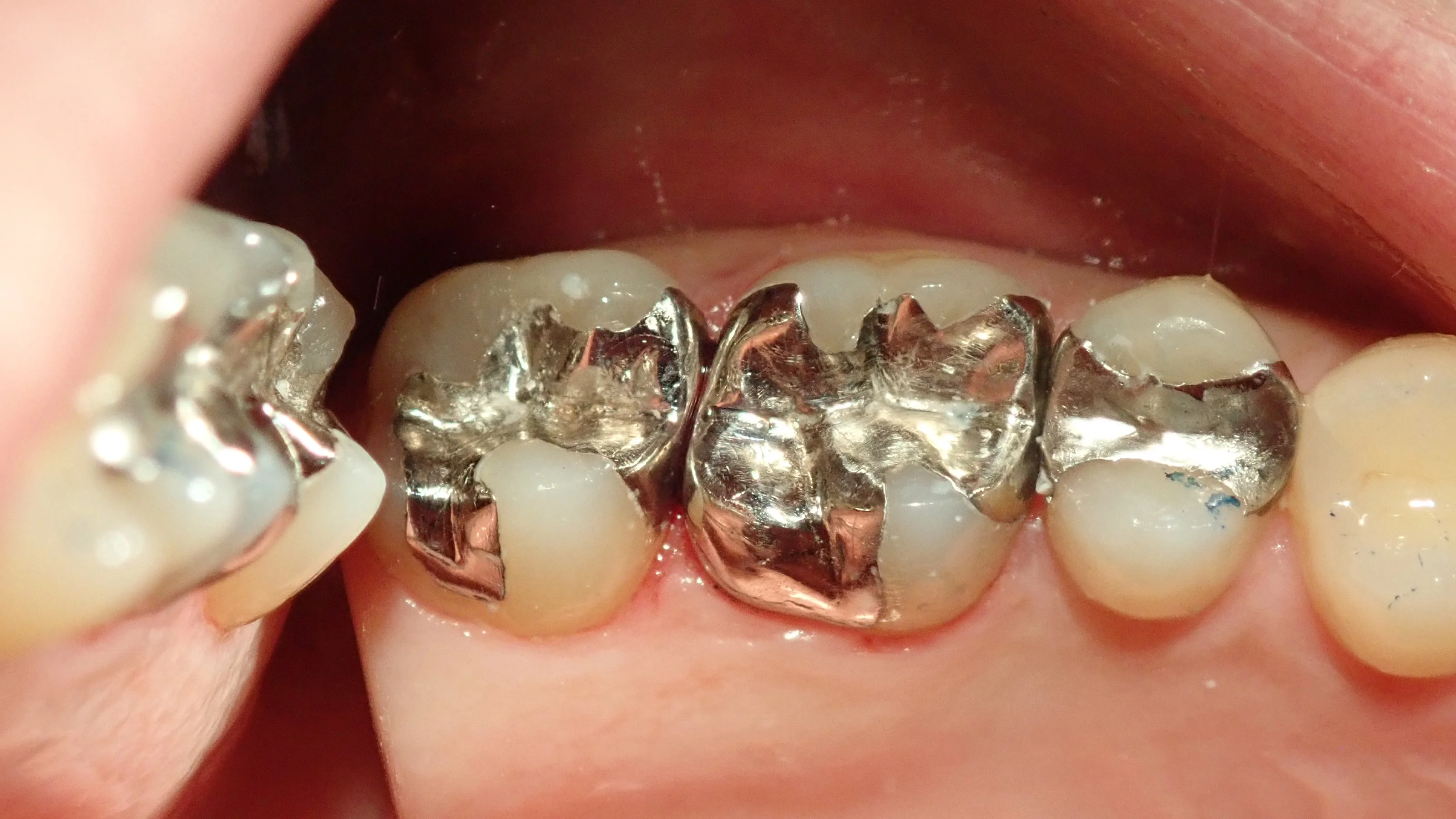 メタルインレー｜坂寄歯科医院（取手市藤代） - 画像4