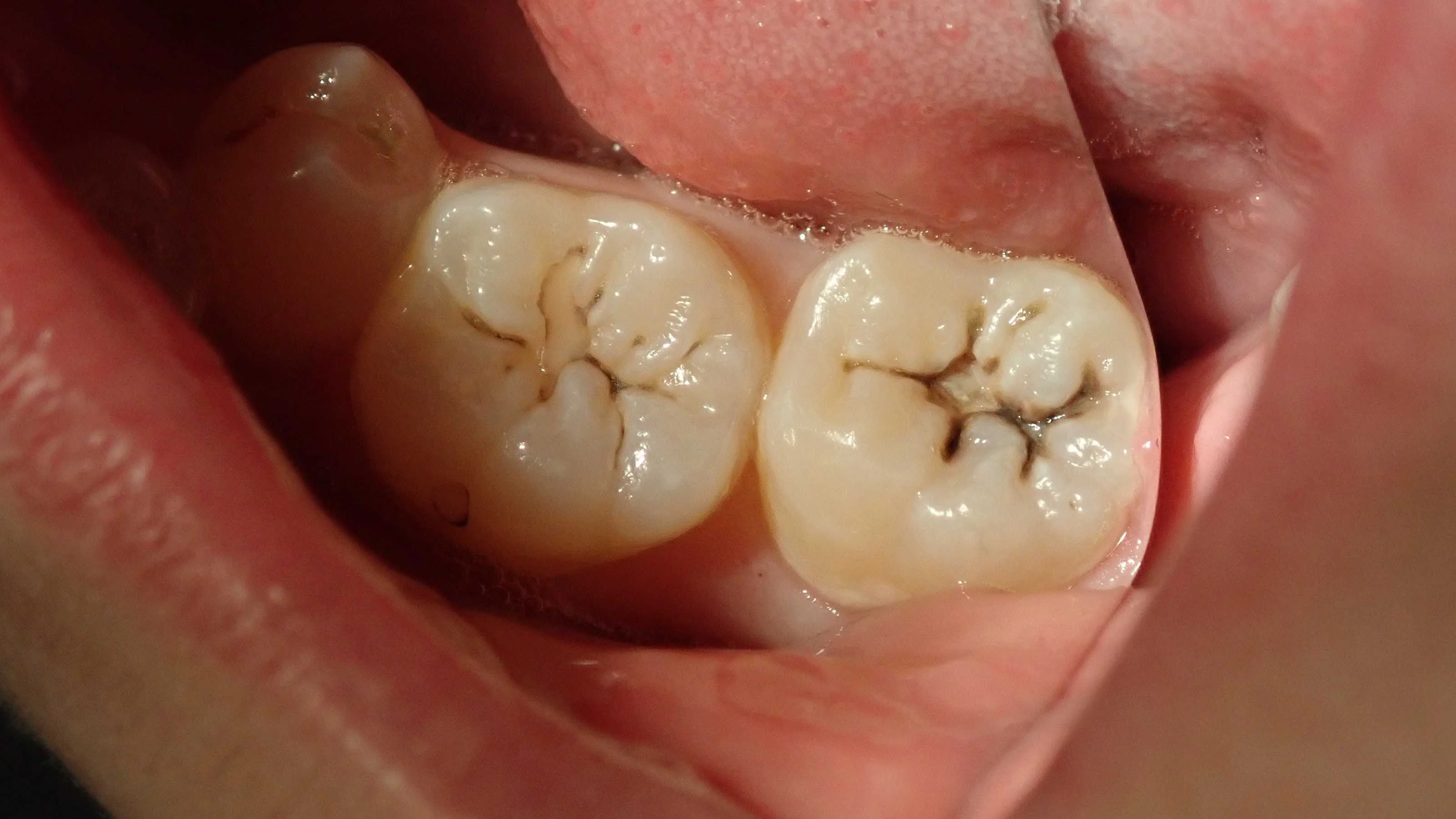 コンポジットレジン修復｜坂寄歯科医院（取手市藤代）