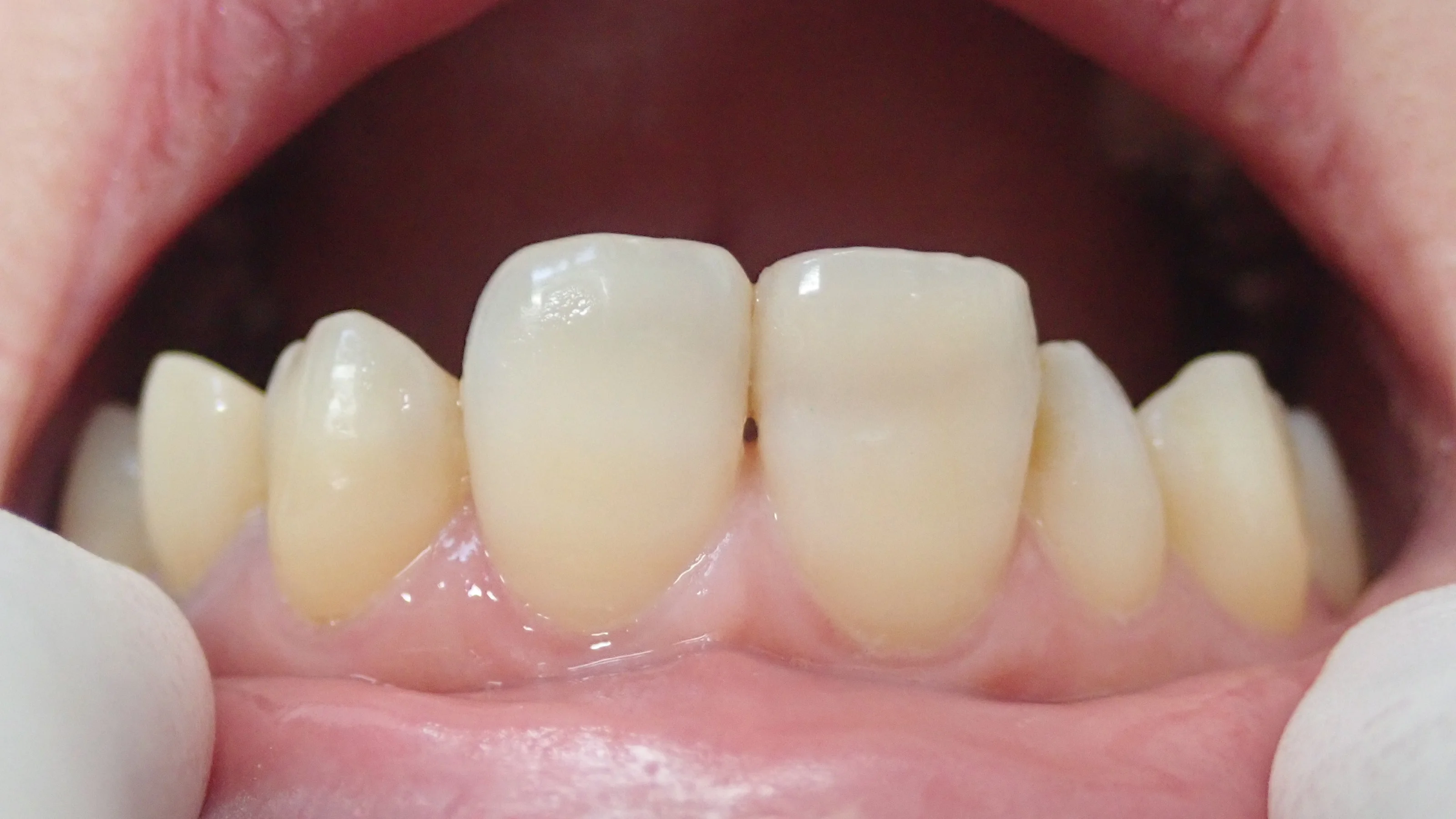 前歯ダイレクトボンディング②|坂寄歯科医院(取手市藤代)