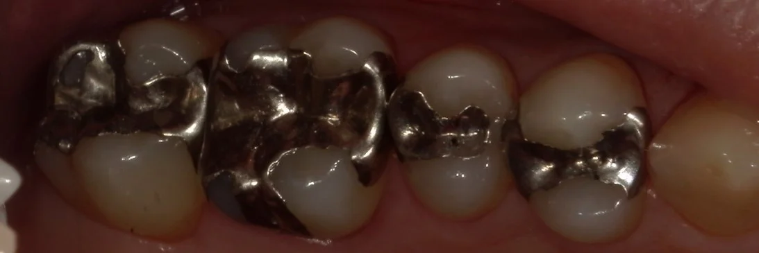 全体的に金属を白い詰め物に。|坂寄歯科医院(取手市藤代)