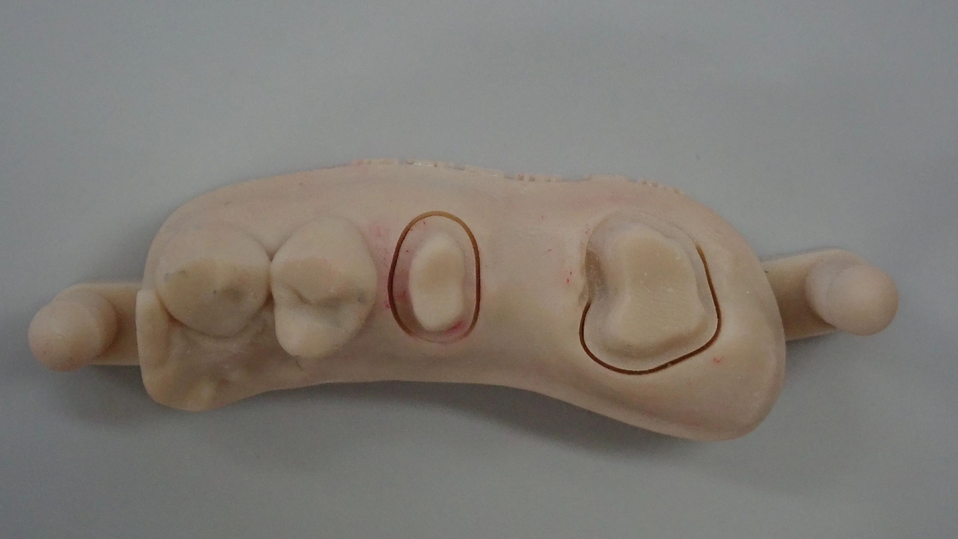 奥歯のセラミックブリッジ|坂寄歯科医院(取手市藤代)
