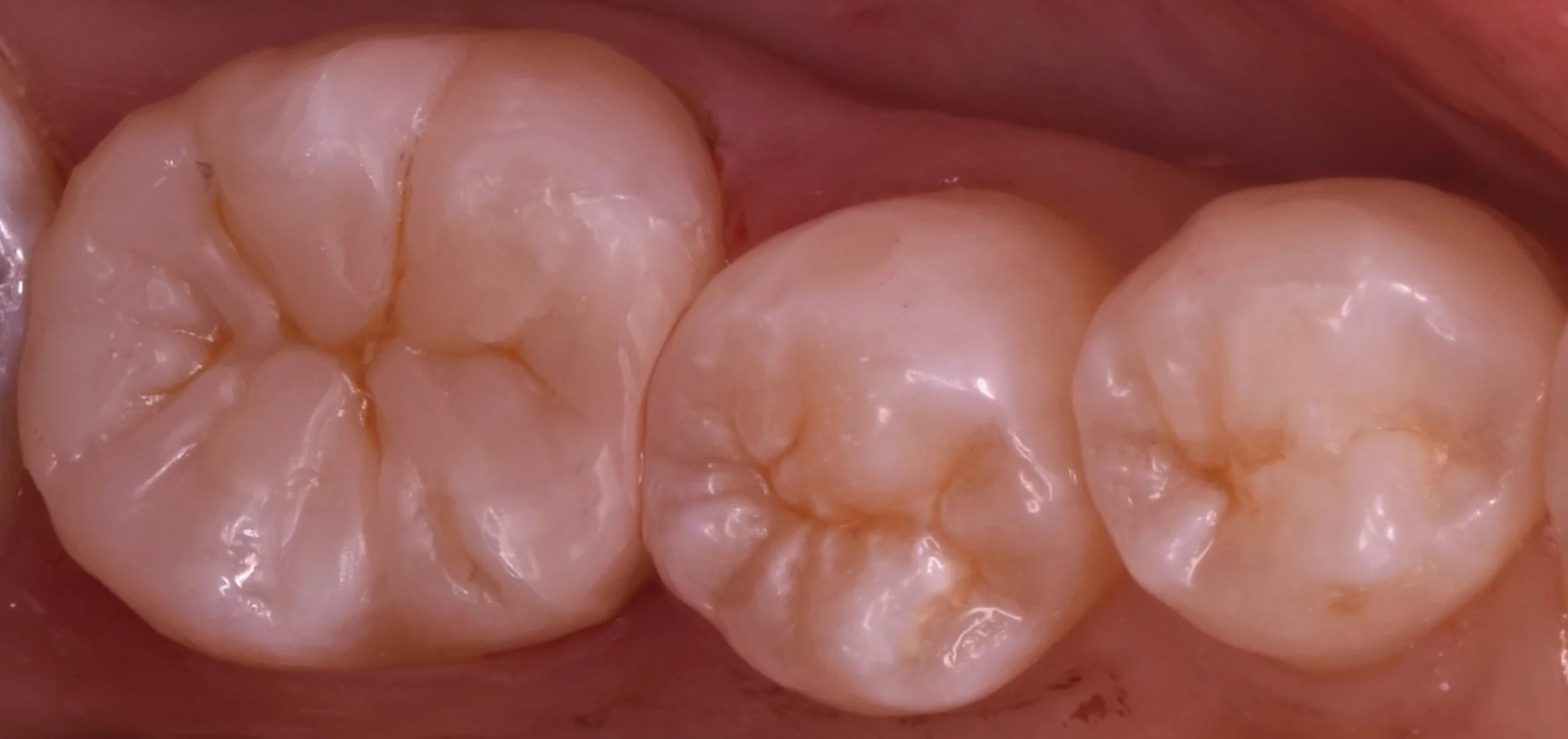 詰め物が脱離した所を即日で白い詰め物に。｜坂寄歯科医院（取手市藤代） - 画像4