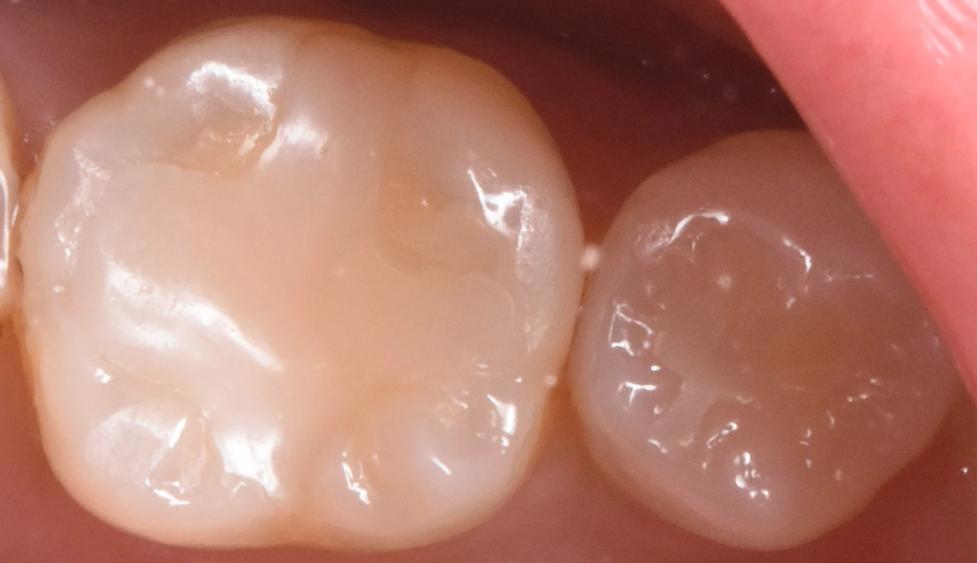 奥歯を白い詰め物で治療。|坂寄歯科医院(取手市藤代)