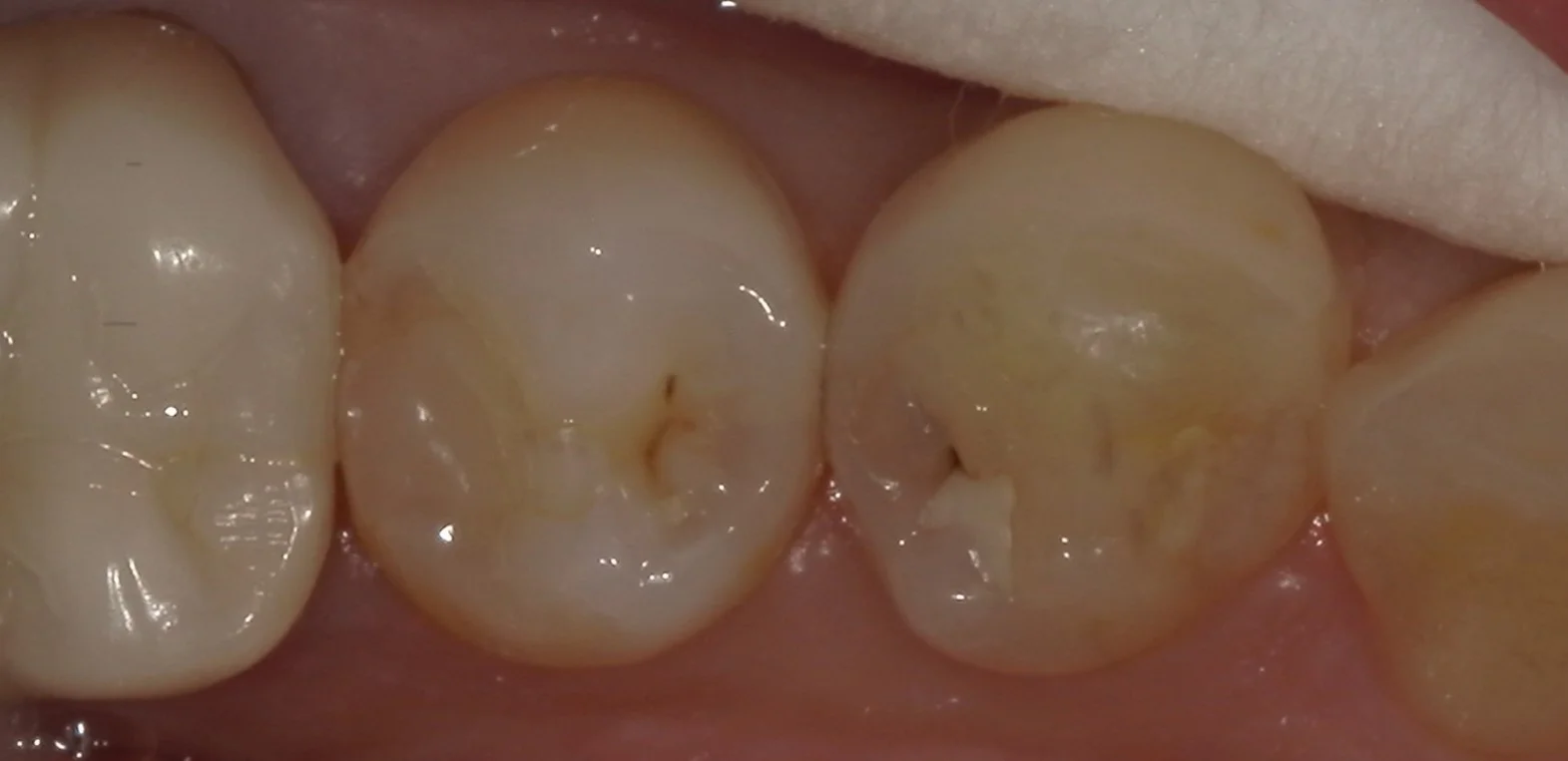 右下奥歯を纏めて治療。遠方からの通院。｜坂寄歯科医院（取手市藤代）