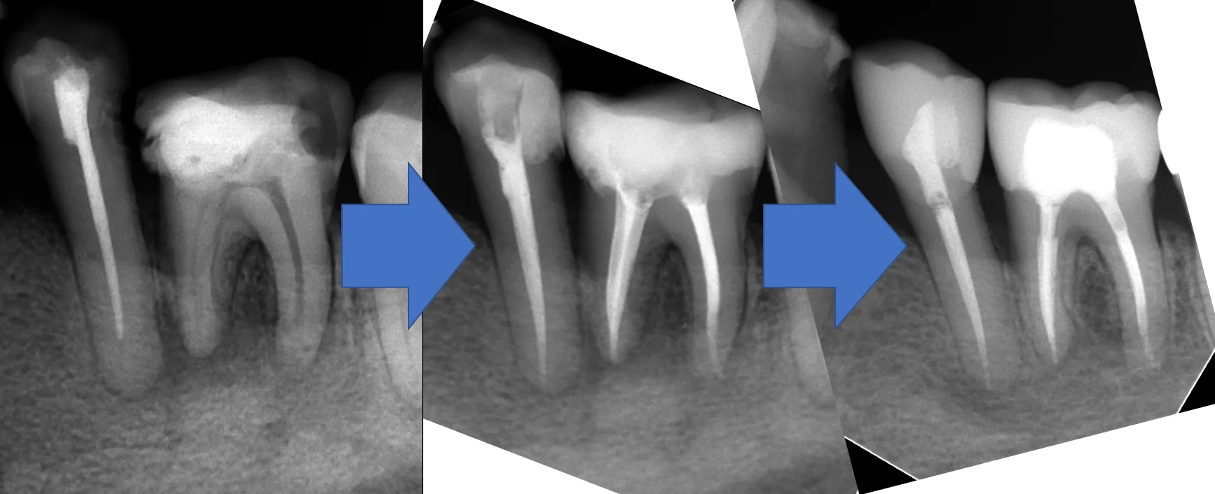 レジンでは無理ですって！再び･･･｡｜坂寄歯科医院（取手市藤代） - 画像4