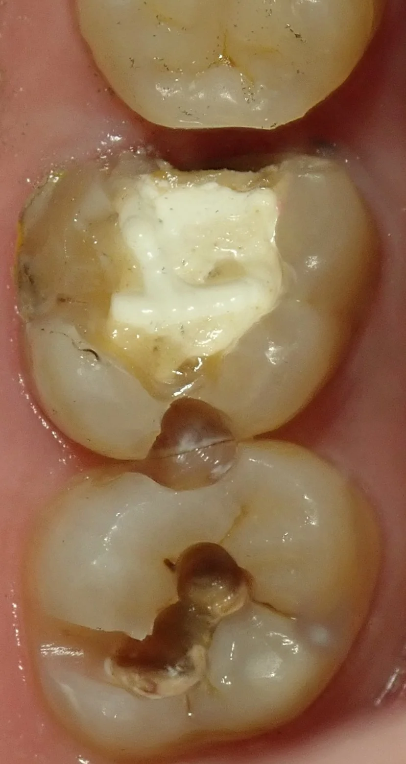 左上奥歯の白い詰め物|坂寄歯科医院(取手市藤代) - 画像2