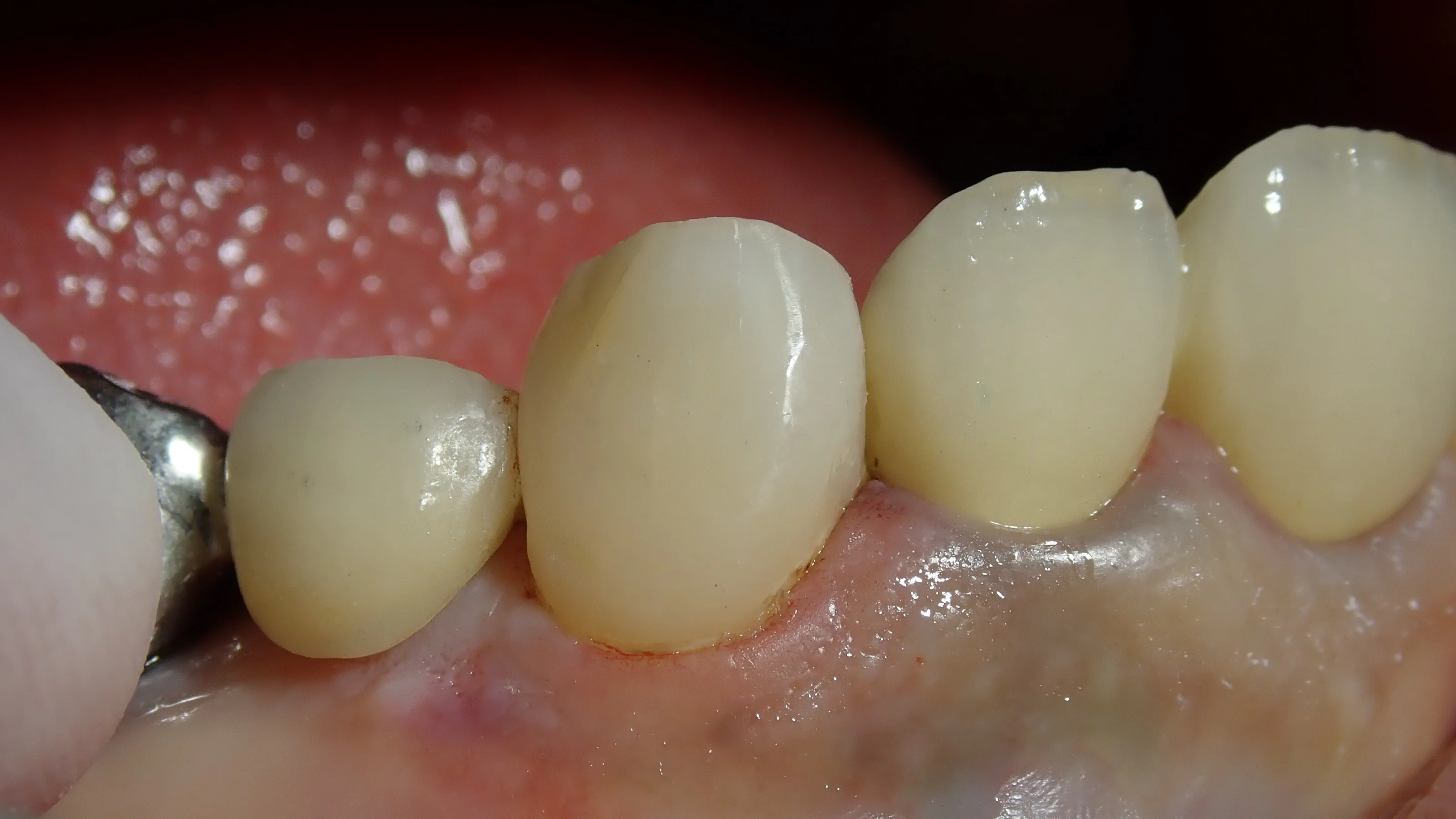 犬歯ダイレクトボンディング｜坂寄歯科医院（取手市藤代） - 画像4