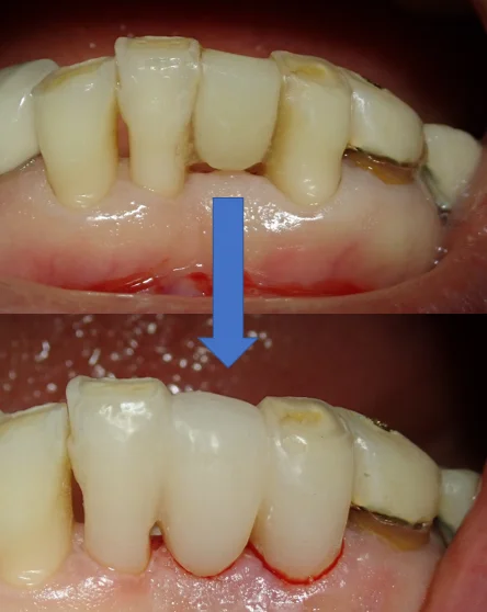 接着性ブリッジ|坂寄歯科医院(取手市藤代) - 画像4