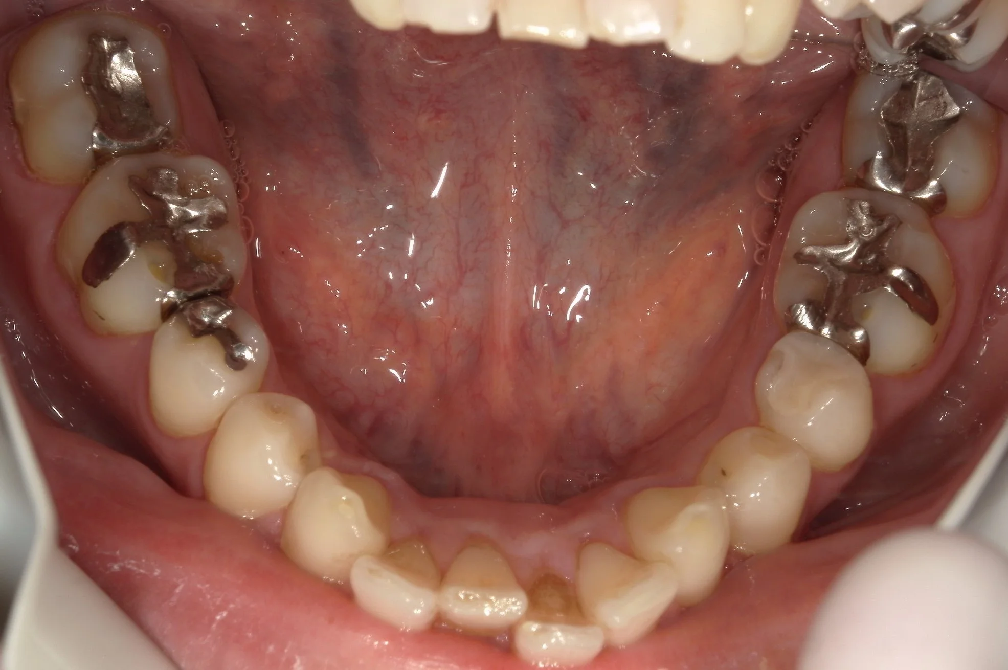 1回で纏めて一気に白い歯へ。|坂寄歯科医院(取手市藤代) - 画像5