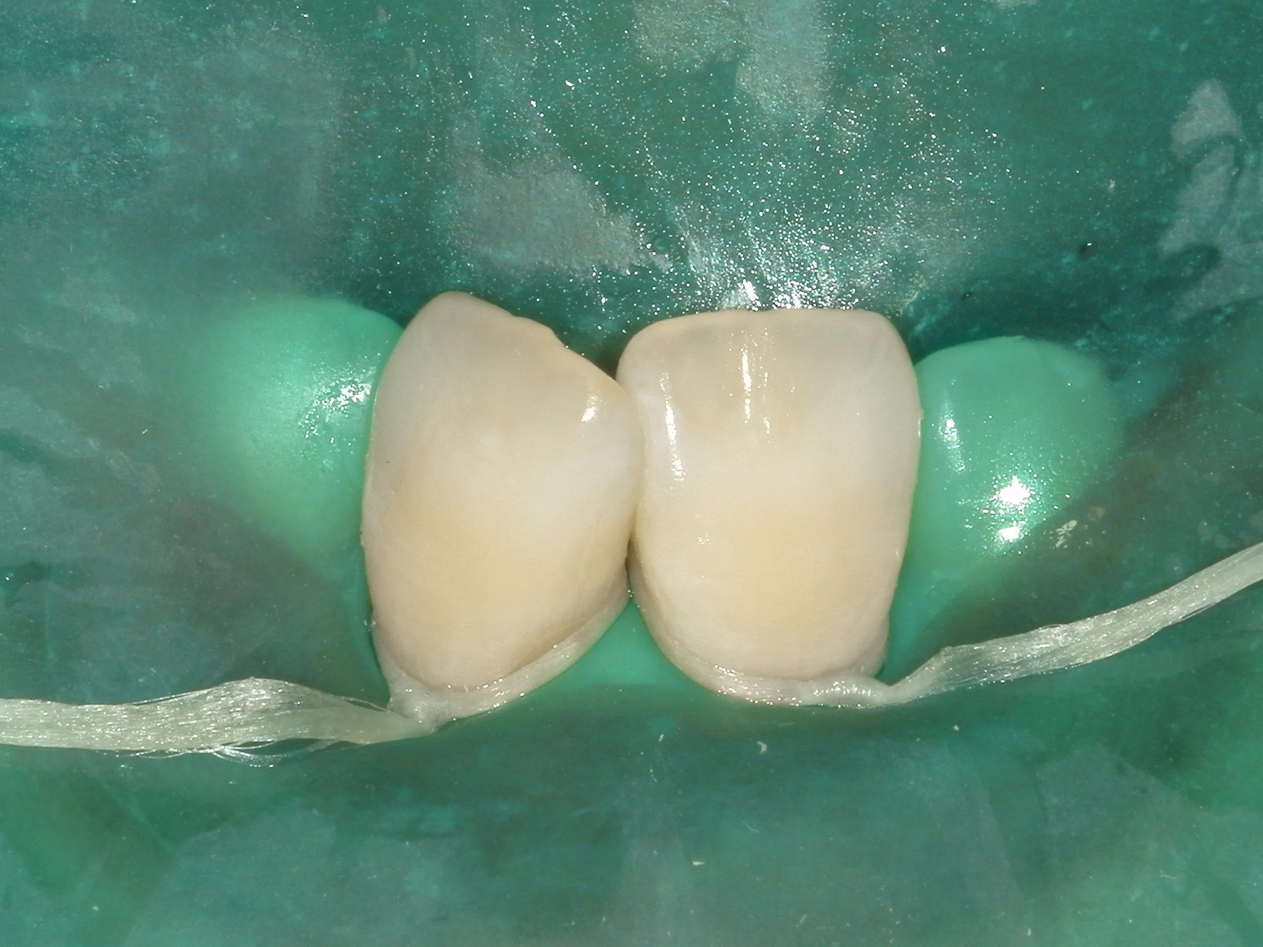 ICON治療(低侵襲ホワイトスポット改善治療)を始めました。｜坂寄歯科医院（取手市藤代） - 画像5