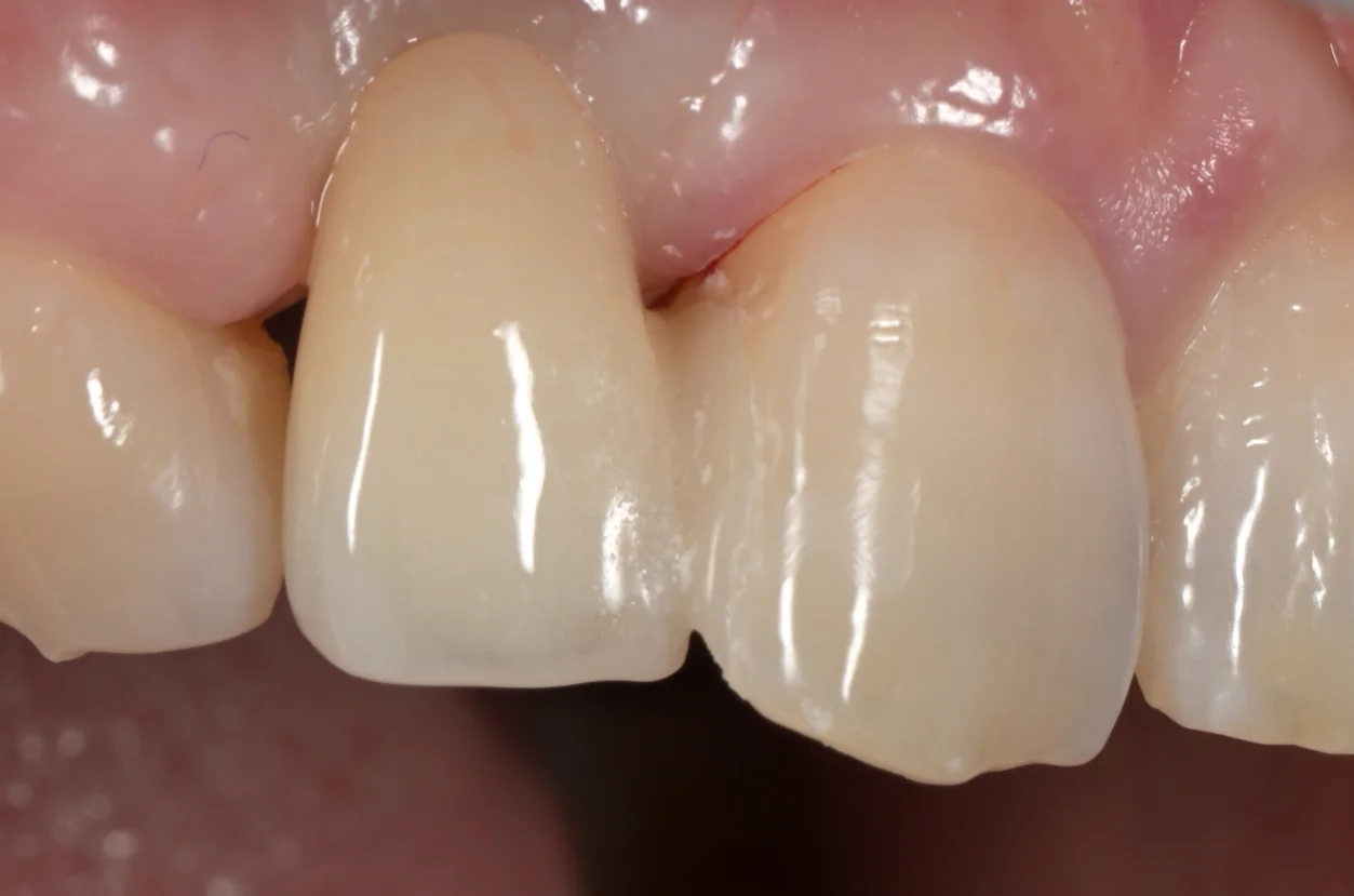 審美治療+歯質保存:延長セラミックブリッジ|坂寄歯科医院(取手市藤代) - 画像5